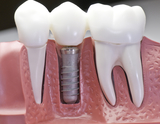  Dental Implants in Chennai No:20 AB,Kanishk complex, Panner Nagar Main Road,VGP Nagar, Mogappair 