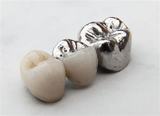  Dental Implants in Chennai No:20 AB,Kanishk complex, Panner Nagar Main Road,VGP Nagar, Mogappair 