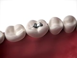  Dental Implants in Chennai No:20 AB,Kanishk complex, Panner Nagar Main Road,VGP Nagar, Mogappair 