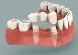  Dental Implants in Chennai No:20 AB,Kanishk complex, Panner Nagar Main Road,VGP Nagar, Mogappair 