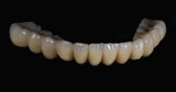 Dental Implants in Chennai No:20 AB,Kanishk complex, Panner Nagar Main Road,VGP Nagar, Mogappair 