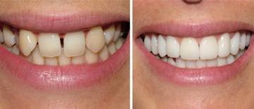 Teeth straightening without braces with OrthoSnap New York Profile Photos of OrthoSnap New York. Straighten Teeth Without Braces. 897 Park Avenue - Photo 6 of 6 Teeth straightening without braces with OrthoSnap New York Profile Photos of OrthoSnap New York. Straighten Teeth Without Braces. 897 Park Avenue - Photo 6 of 6