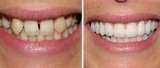 Teeth straightening without braces with OrthoSnap New York OrthoSnap New York. Straighten Teeth Without Braces. 897 Park Avenue 