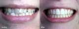 Straighten teeth without braces Brooklyn and Manhattan NY OrthoSnap New York. Straighten Teeth Without Braces. 897 Park Avenue 