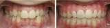 How to straighten teeth without braces OrthoSnap New York OrthoSnap New York. Straighten Teeth Without Braces. 897 Park Avenue 