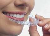 straightening teeth without braces OrthoSnap Brooklyn New York OrthoSnap New York. Straighten Teeth Without Braces. 897 Park Avenue 