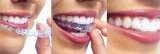 Straighten crooked teeth without braces OrthoSnap New York  OrthoSnap New York. Straighten Teeth Without Braces. 897 Park Avenue 