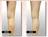 USA Vein Clinics, Johnstown
