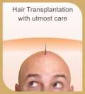Hair Transplantation, SkinCityIndia, Pune