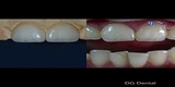  Dental Crowns Lab Elizabeth 10 North Ave 
