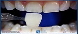 Dental Crowns Lab, Staten Island