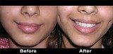 Dimple Creation in Mumbai - Aesthetic Clinic, Mumbai
