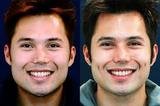 Dimple Creation in Mumbai - Aesthetic Clinic, Mumbai