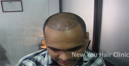  Profile Photos of Hair Transplant in Bangalore # 75/1, 17th Main, Jyoti Nivas College Road, Kormangala 5th block, Above Hyderabad House - Photo 3 of 5