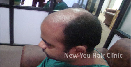  Profile Photos of Hair Transplant in Bangalore # 75/1, 17th Main, Jyoti Nivas College Road, Kormangala 5th block, Above Hyderabad House - Photo 1 of 5