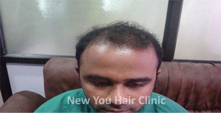  Profile Photos of Hair Transplant in Bangalore # 75/1, 17th Main, Jyoti Nivas College Road, Kormangala 5th block, Above Hyderabad House - Photo 2 of 5