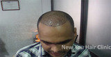  Hair Transplant in Bangalore # 75/1, 17th Main, Jyoti Nivas College Road, Kormangala 5th block, Above Hyderabad House 