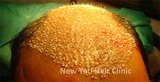 Hair Transplant in Bangalore, Bangalore