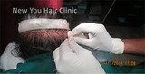 Hair Transplant in Bangalore, Bangalore