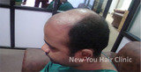 Hair Transplant in Bangalore, Bangalore