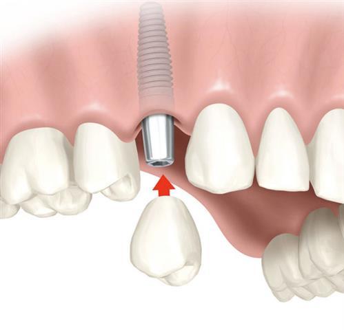  Profile Photos of Affordable Dental Implants Albany 816 Central Ave - Photo 1 of 4