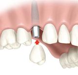 Affordable Dental Implants Albany, Albany