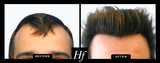 Hair Free Laser Skin Clinics Toronto Hairfree Laser Skin Clinics 2100 Bloor St W #7b, 