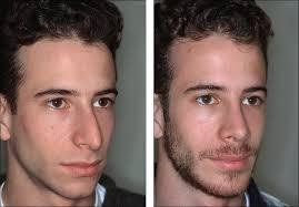 Chin Augmentation Profile Photos of Chin Augmentation in Mumbai at Aesthetic Clinic 7th Floor, Convention Centre Wing, Kokilaben Dhirubhai Ambani Hospital - Photo 2 of 3