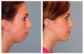 Chin Augmentation Profile Photos of Chin Augmentation in Mumbai at Aesthetic Clinic 7th Floor, Convention Centre Wing, Kokilaben Dhirubhai Ambani Hospital - Photo 3 of 3