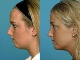 Chin Augmentation, Chin Augmentation in Mumbai at Aesthetic Clinic, Mumbai