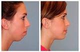 Chin Augmentation, Chin Augmentation in Mumbai at Aesthetic Clinic, Mumbai